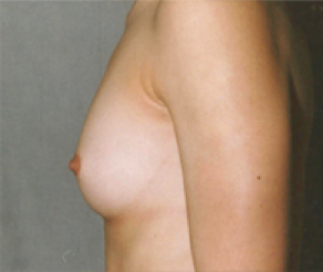 Breast Implants Before