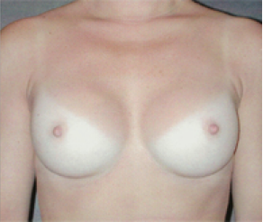 Breast Implants After