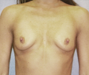 Breast Implants Before