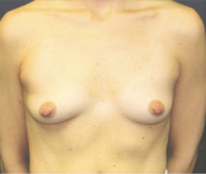 Breast Implants Before