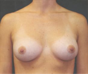 Breast Implants After