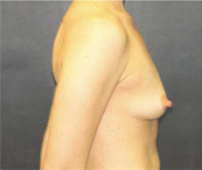 Breast Implants Before