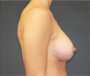 Breast Implants After