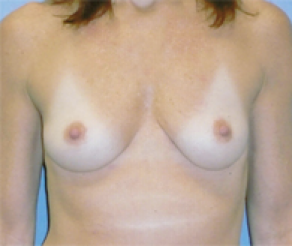 Breast Implants Before