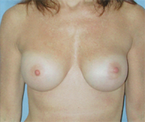 Breast Implants After