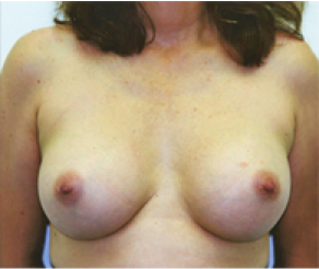 Breast Implants After