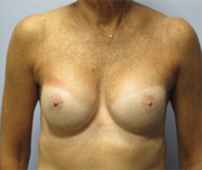 Breast Implants After