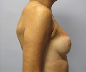 Breast Implants After