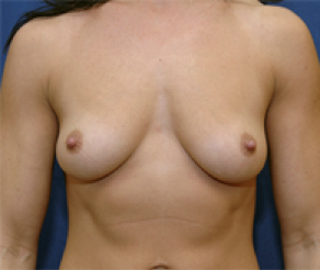 Breast Implants Before