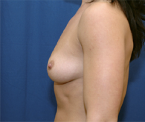 Breast Implants Before