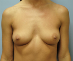 Breast Implants Before