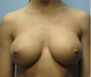 Breast Implants After