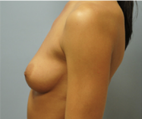 Breast Implants Before