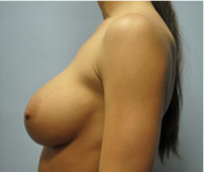 Breast Implants After