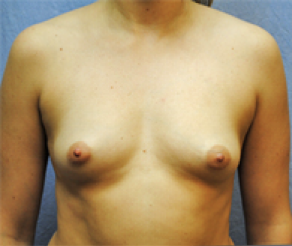 Breast Implants Before