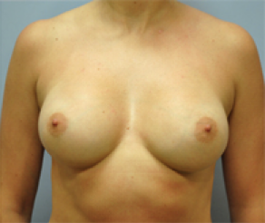 Breast Implants After