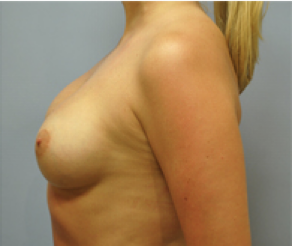 Breast Implants After