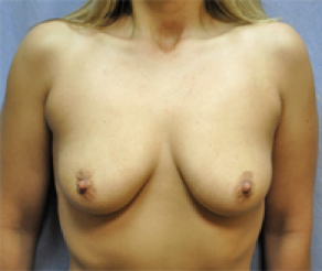 Breast Implants Before