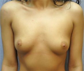 Breast Implants Before