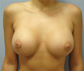 Breast Implants After