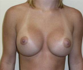 Breast Implants After