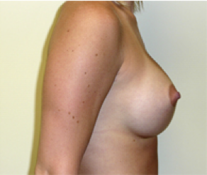 Breast Implants After