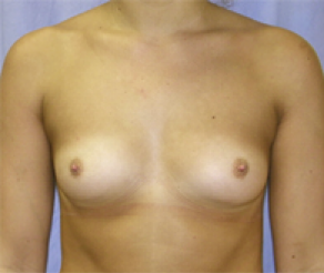 Breast Implants Before