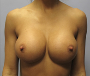 Breast Implants After