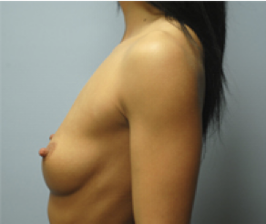 Breast Implants Before