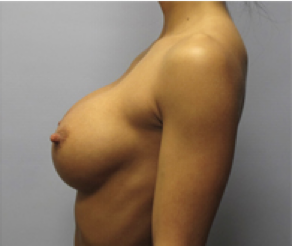 Breast Implants After