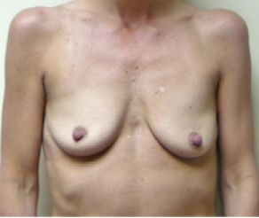 Breast Implants with Lift Before