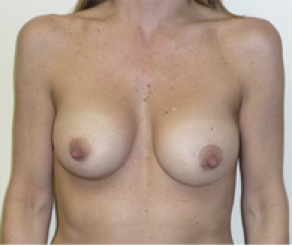 Breast Implants with Lift After