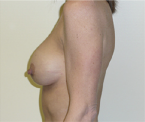 Breast Implants with Lift After