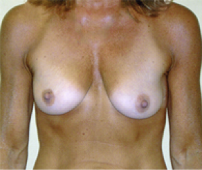 Breast Implants with Lift Before