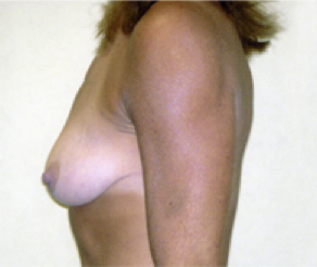 Breast Implants with Lift Before