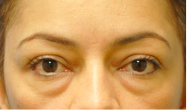 Eyelid Surgery Before