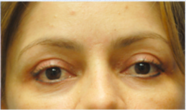 Eyelid Surgery After