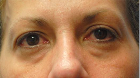 Eyelid Surgery Before