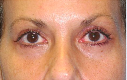 Eyelid Surgery After