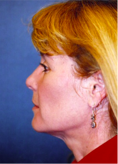 Facelift Before