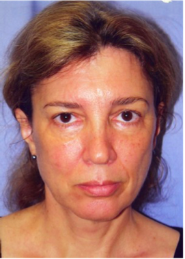 Facelift Before