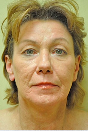 Facelift Before