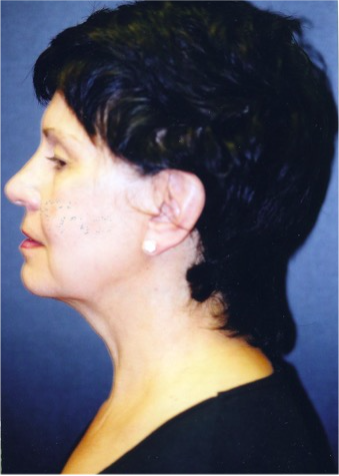 Facelift Before