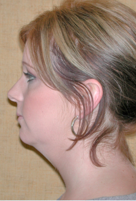 Neck Liposuction, Platysmaplasty, Chin Implant Before