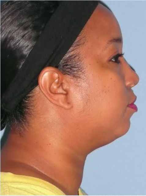 Neck Liposuction, Platysmaplasty, Chin Implant Before