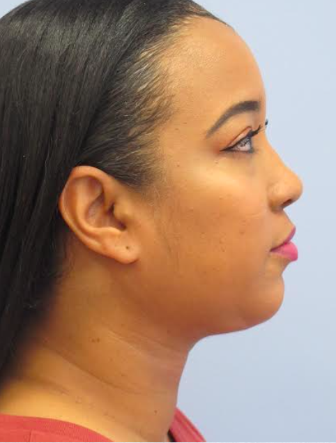 Neck Liposuction, Platysmaplasty, Chin Implant After