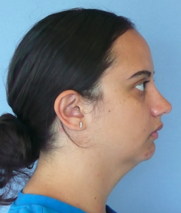 Neck Liposuction, Platysmaplasty, Chin Implant Before