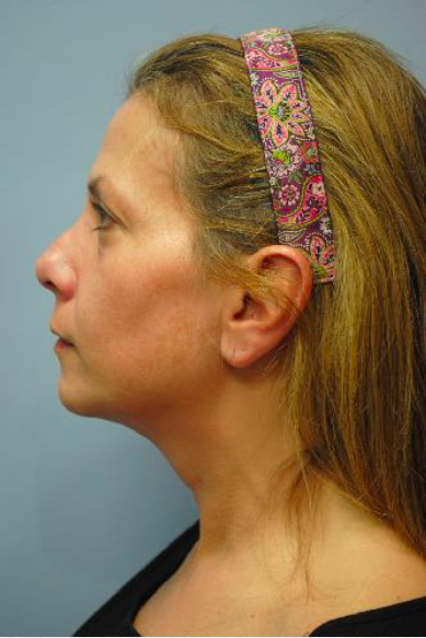 Neck Liposuction, Platysmaplasty, Chin Implant Before