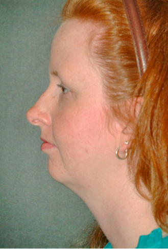 Neck Liposuction, Platysmaplasty, Chin Implant Before