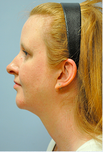 Neck Liposuction, Platysmaplasty, Chin Implant After